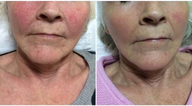 rosacea results