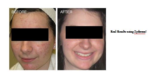 results using zyderma